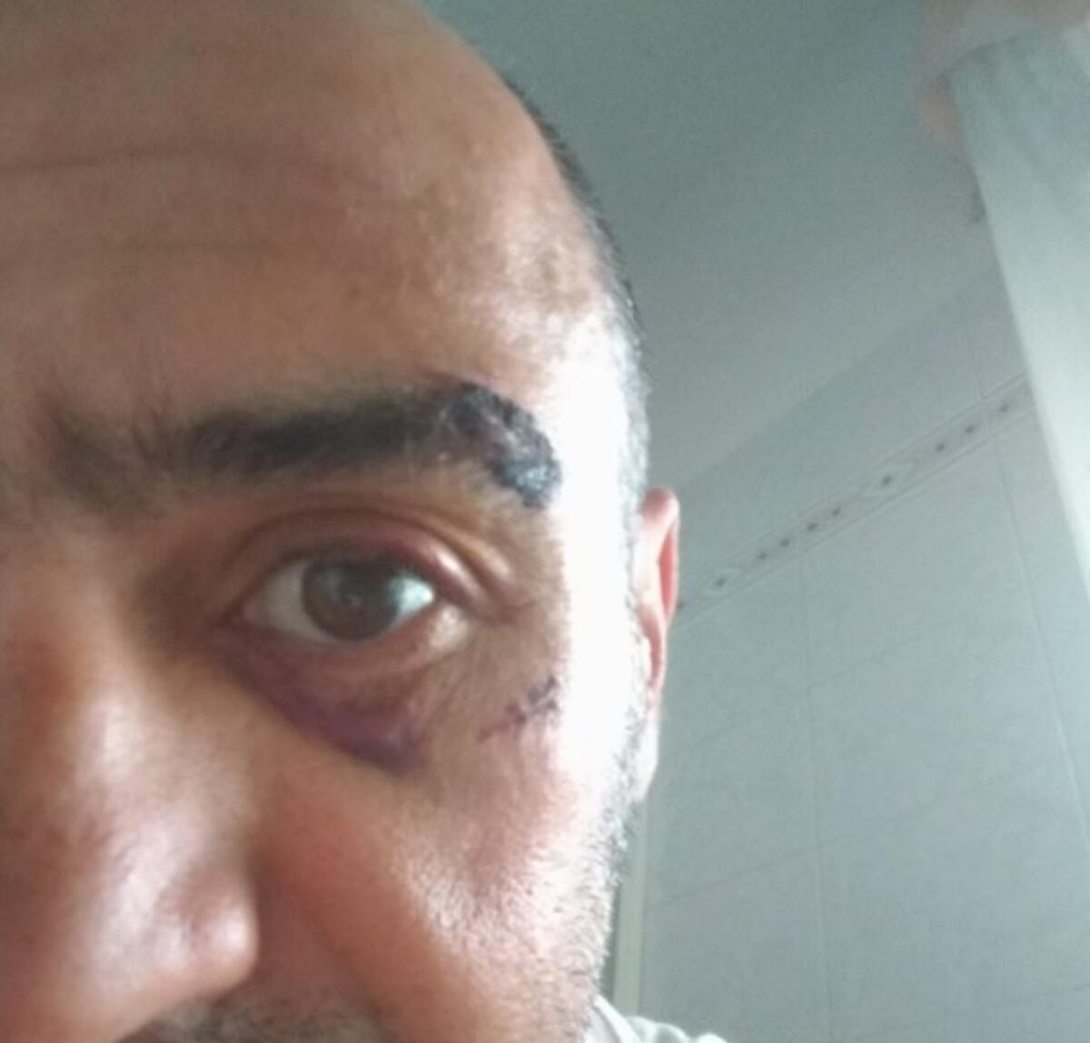 PATERNO': Ciclista picchiato da automobilista, gli frattura lo zigomo e rompe il timpano - 