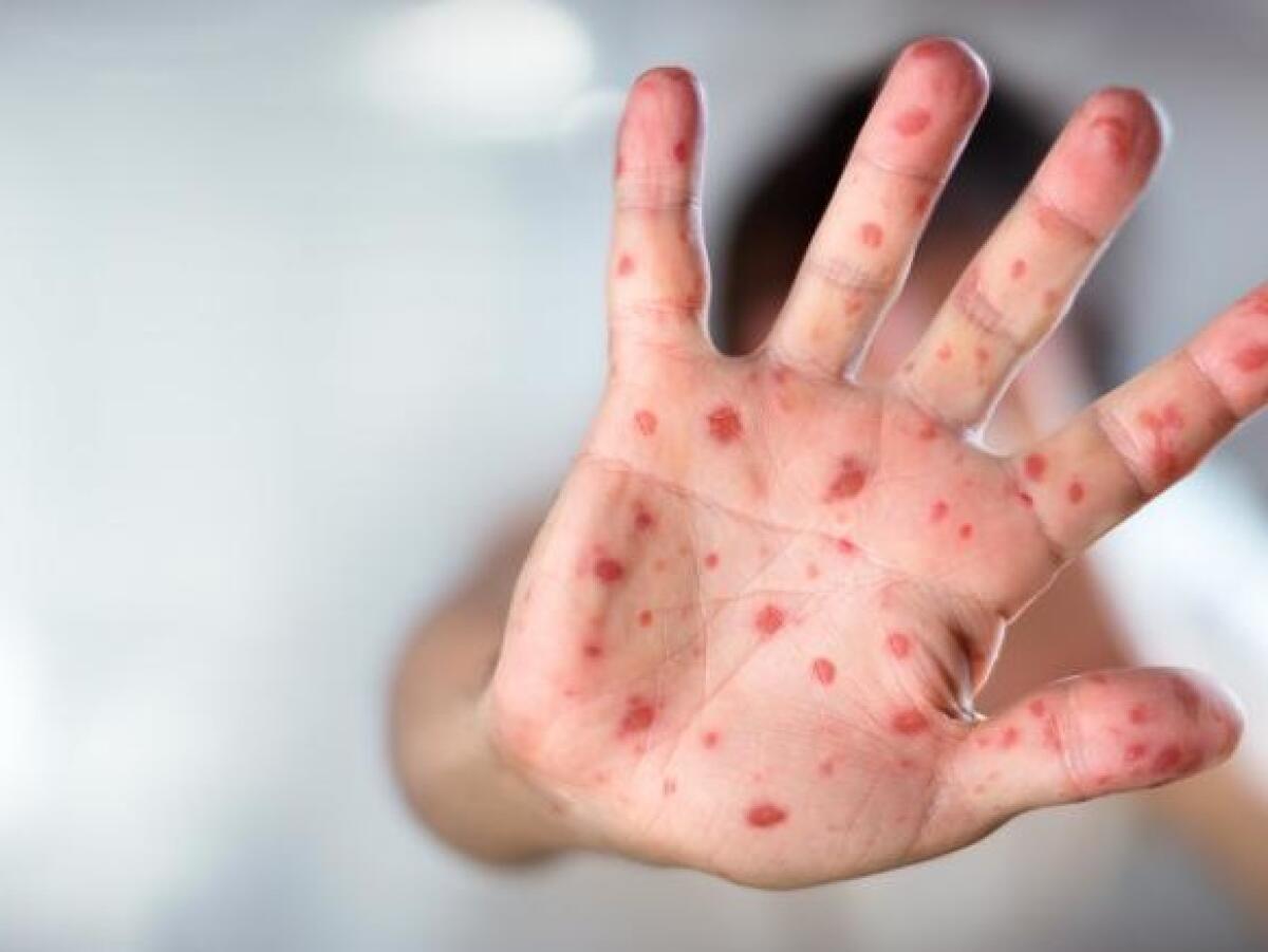 A CATANIA TROPPI CASI DI MORBILLO: “COLPITI SOPRATTUTTO GIOVANI ADULTI” - 