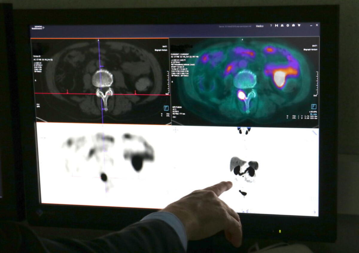 TUMORE DELLA PROSTATA, IN USO NUOVO RADIOFARMACO “ESAME PET SPECIFICO PIÙ SENSIBILE IN CASO DI RECIDIVA” - 