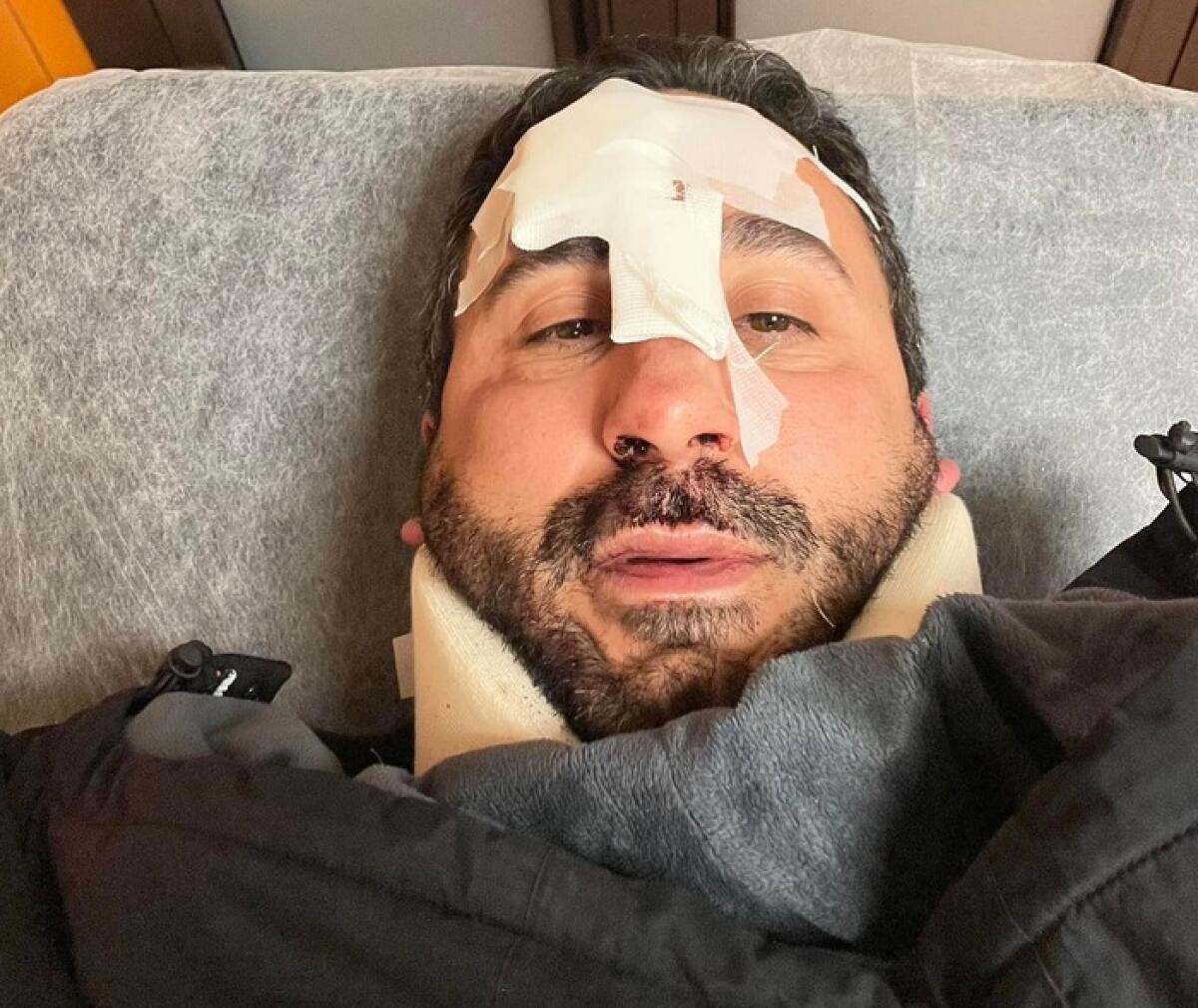 NATALE GIUNTA, LO CHEF CADE IN UNA BUCA CON IL MONOPATTINO A PALERMO: «NASO ROTTO E TRAUMI OVUNQUE» - 