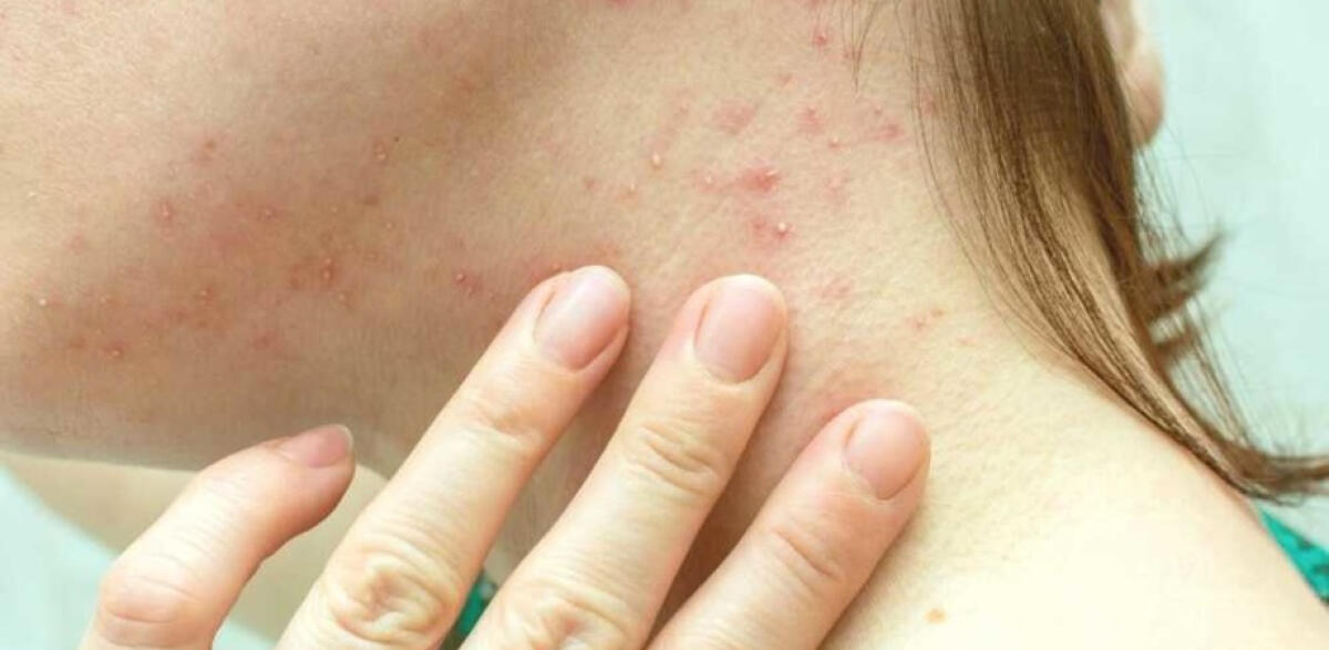 PRIMO CASO IN SICILIA DI VAIOLO DELLE SCIMMIE - 