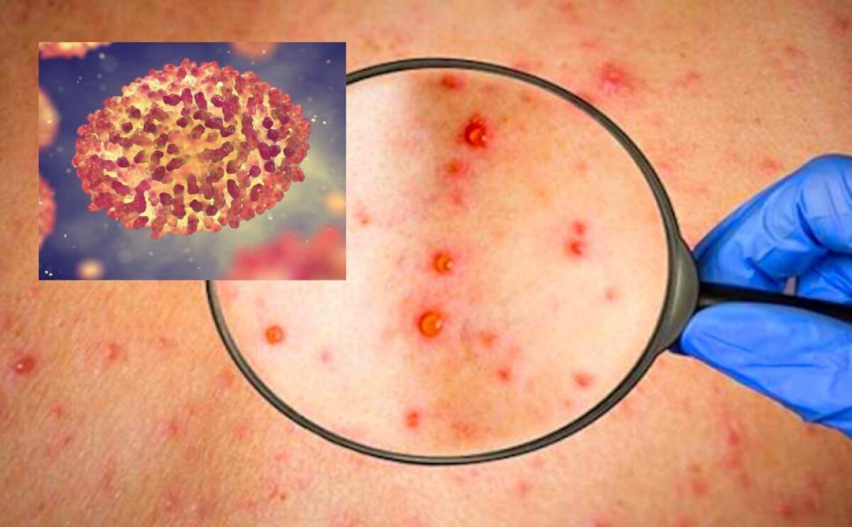 VAIOLO DELLE SCIMMIE: IN ITALIA 505 CASI, 26 IN PIÙ IN 4 GIORNI. MINISTERO “POSSIBILI QUARANTENE” - 