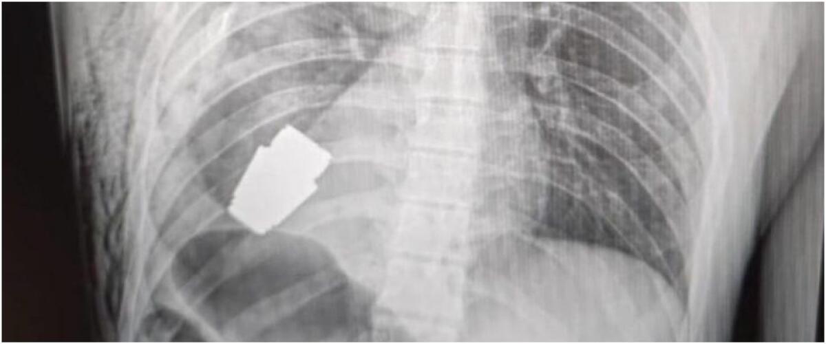 UCRAINA, GRANATA INESPLOSA RIMOSSA DAL PETTO DI UN SOLDATO: "FINIRÀ NEI LIBRI DI MEDICINA" - 