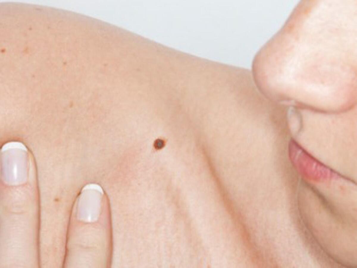 PREVENZIONE MELANOMA, SABATO 27 SCREENING GRATUITI PER IL CONTROLLO DEI NEI AL POLICLINICO DI CATANIA - 