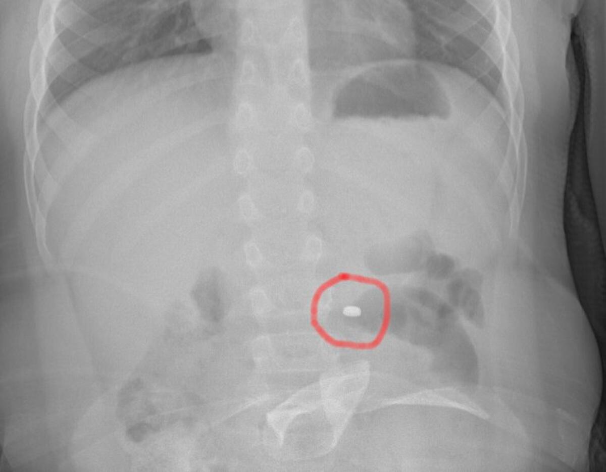 BIMBO INGOIA PILA “A BOTTONE”, ESTRATTA IN SALA OPERATORIA: IL PICCOLO STA BENE - 