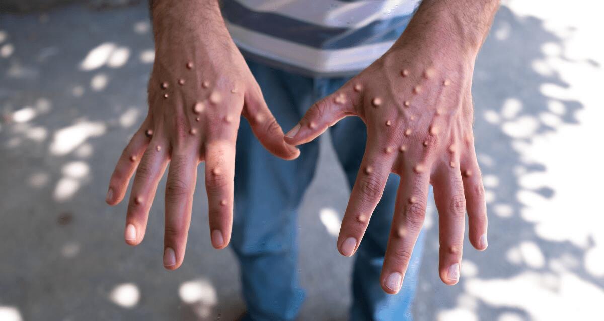 L’OMS DICHIARA LO STATO DI EMERGENZA INTERNAZIONALE PER IL VAIOLO DELLE SCIMMIE - 