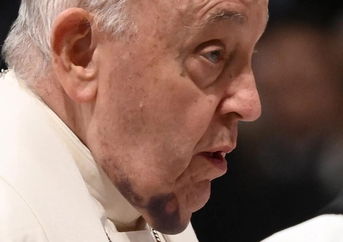 IL PAPA E IL VISTOSO EMATOMA SUL COLLO: “HA BATTUTO IL MENTO SUL COMODINO”,  NOMINATI 21 NUOVI CARDINALI, TRA CUI 5 ITALIANI - 