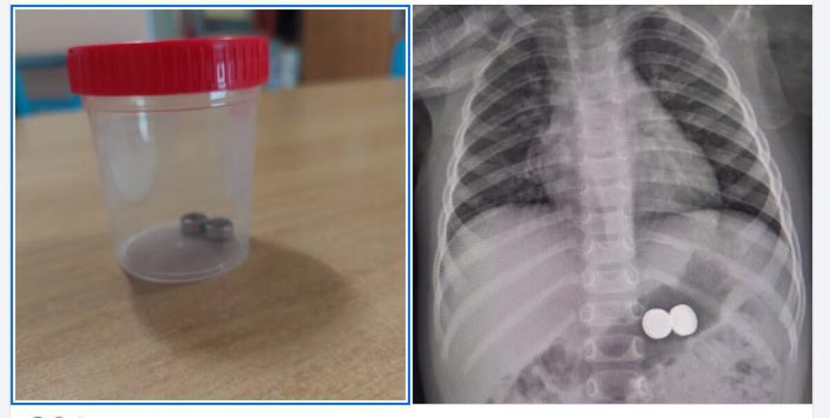 BIMBA DI UN ANNO INGERISCE BATTERIE: SALVATA DAI MEDICI DEL GARIBALDI-NESIMA - 