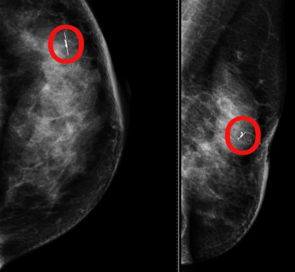 AL CANNIZZARO DI CATANIA UN INNOVATIVO "MINI-GPS" PER LA CHIRURGIA SENOLOGICA: PRIMA VOLTA NEL SUD ITALIA - 