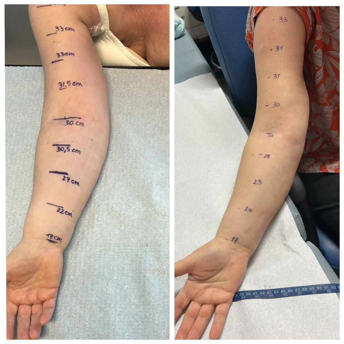 Catania, operazione innovativa al Cannizzaro: ricostruzione del seno e cura del linfedema insieme - 